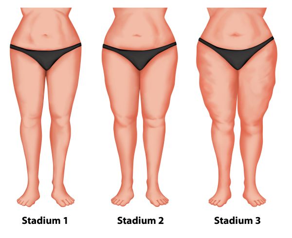 Stadien_Lipoedem